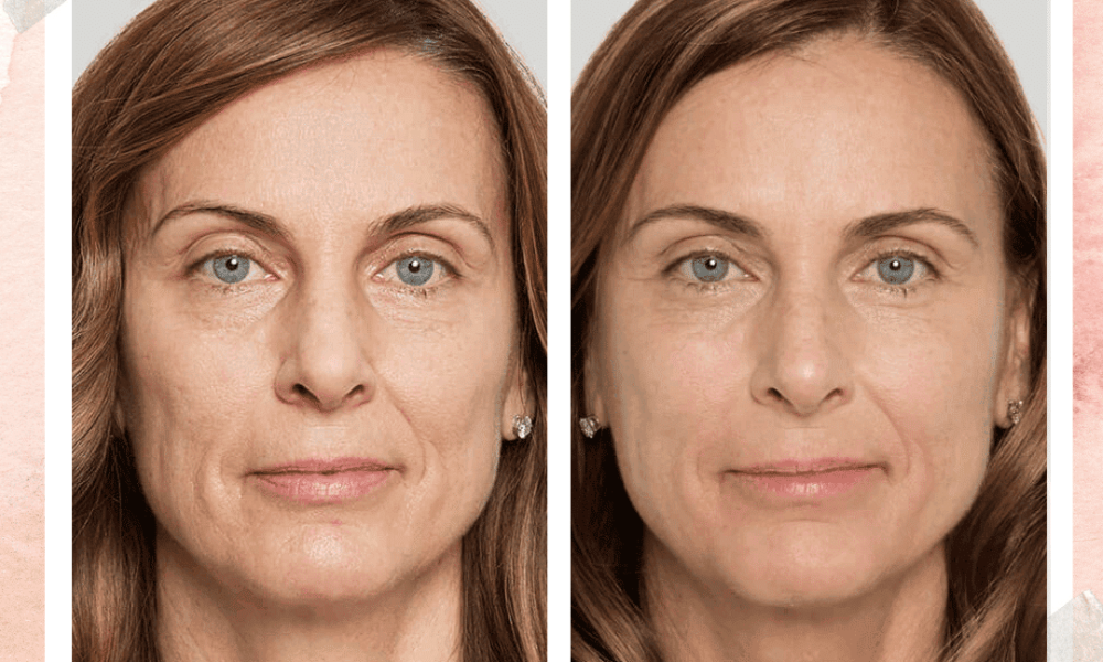 Young Female Sculptra Before and after Treatment result | River Oaks Skin Institute in Houston, TX